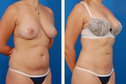 Liposuction Before and After 08
