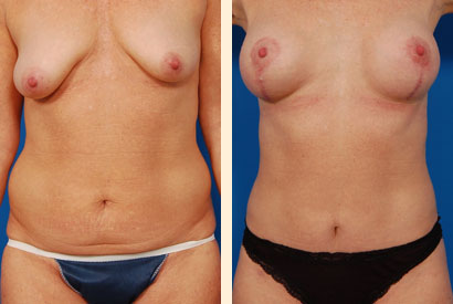 Liposuction Before and After 15