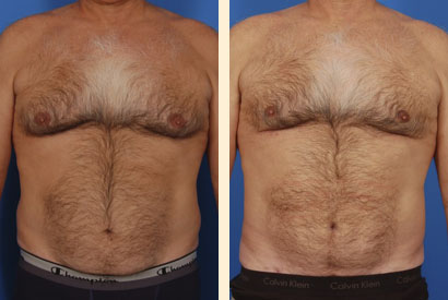 Male Breast Reduction Before and After 02