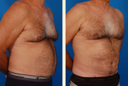 Male Breast Reduction Before and After 02