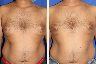 Male Breast Reduction Before and After 01