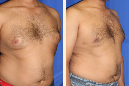 Male Breast Reduction Before and After 03