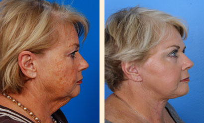 Necklift Before and After 02
