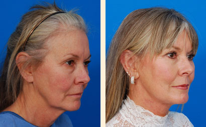 Necklift Before and After 01