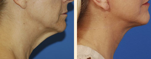 Necklift Before and After 09