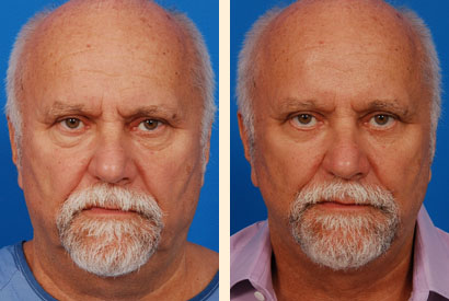Necklift Before and After 01