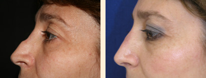 Revision Rhinoplasty Before and After 01