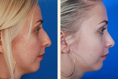 Rhinoplasty Before and After 06