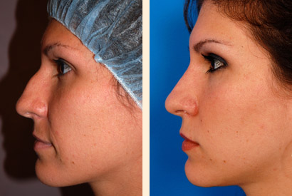 Rhinoplasty Before and After 05