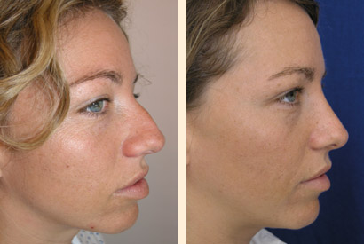 Rhinoplasty Before and After 08
