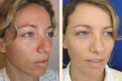 Rhinoplasty Before and After 03