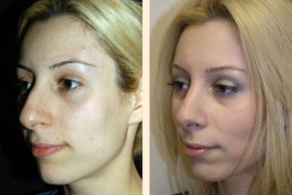 Rhinoplasty Before and After 04