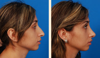 Rhinoplasty Before and After 06