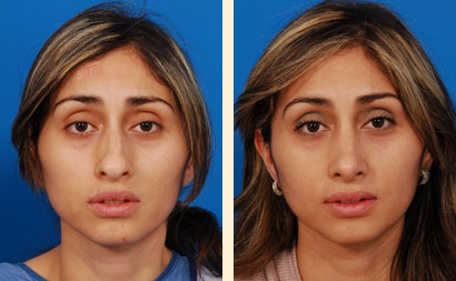 Rhinoplasty Before and After 05
