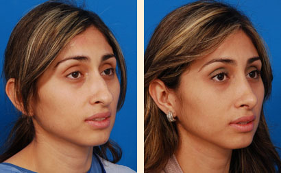 Rhinoplasty Before and After 05