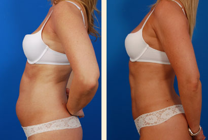 Slimlipo Before and After 11