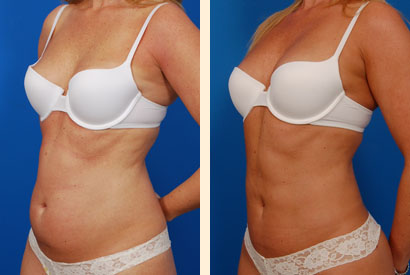 Slimlipo Before and After 01