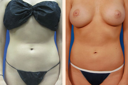 Slimlipo Before and After 01