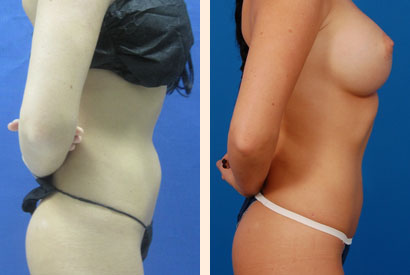 Slimlipo Before and After 06