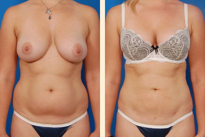 Slimlipo Before and After 07