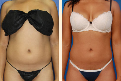 Slimlipo Before and After 10