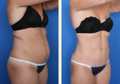 Slimlipo Before and After 12
