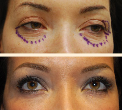 Traditional Eyelid Lift Before and After 06
