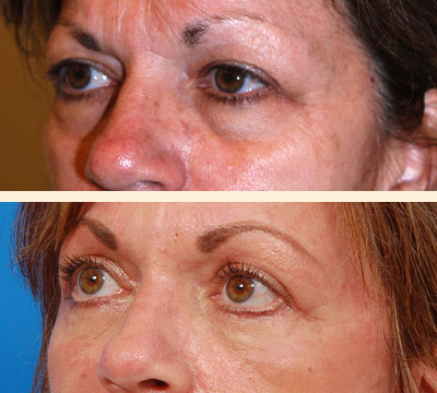 Traditional Eyelid Lift Before and After 08