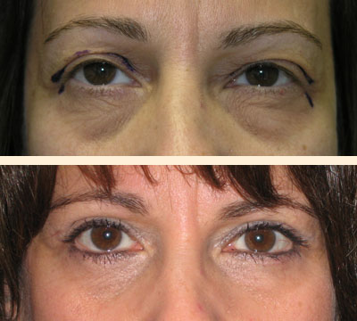Traditional Eyelid Lift Before and After 12