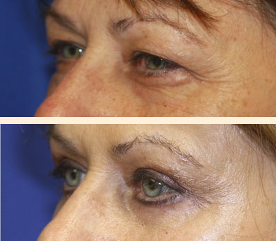Traditional Eyelid Lift Before and After 05