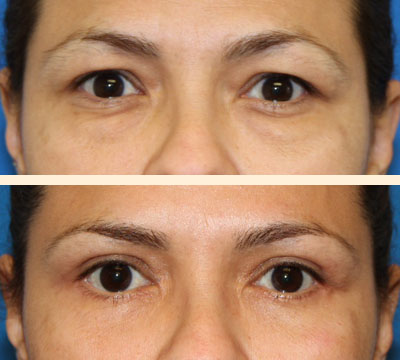 Traditional Eyelid Lift Before and After 12