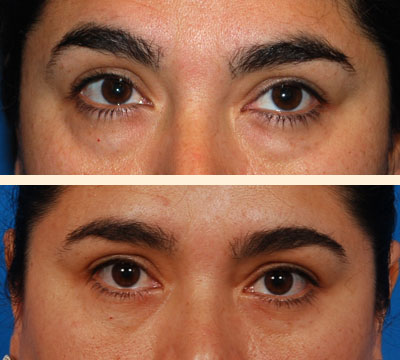 Traditional Eyelid Lift Before and After 13