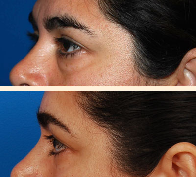 Traditional Eyelid Lift Before and After 07