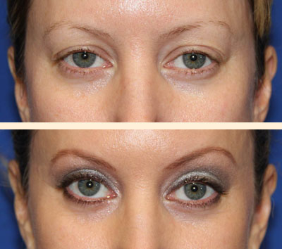 Traditional Eyelid Lift Before and After 13