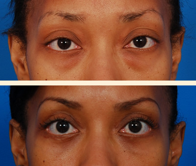 Traditional Eyelid Lift Before and After 11