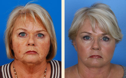 Traditional Eyelid Lift Before and After 07