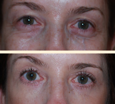 Transconjunctival Eyelid Lift Before and After 01