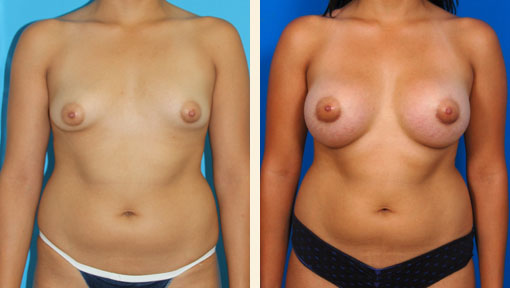 Tuberous Breast Correction Before and After 02