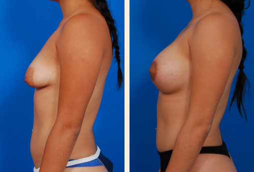 Tuberous Breast Correction Before and After 04
