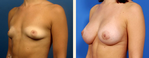 Tuberous Breast Correction Before and After 06