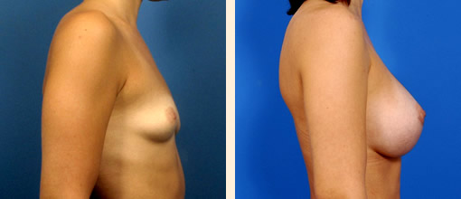 Tuberous Breast Correction Before and After 05