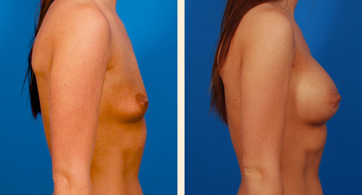 Tuberous Breast Correction Before and After 06